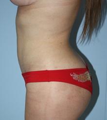 after Body Sculpting 6