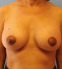 after Breast Lift 5