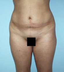 before Body Sculpting 8