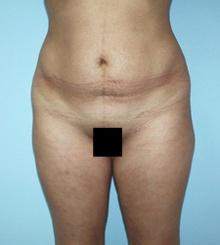before Body Sculpting 8