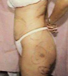 before Brazilian Butt Lift 26