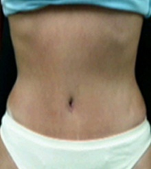 after Tummy Tuck 20