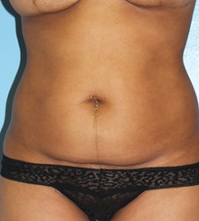 before Tummy Tuck 23