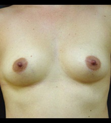 before Breast Augmentation 30