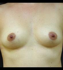 before Breast Augmentation 30
