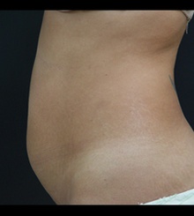 before Tummy Tuck 7