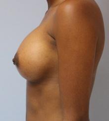 after Breast Augmentation 47