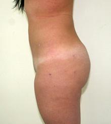 after Brazilian Butt Lift 8