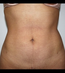 after Body Sculpting 13