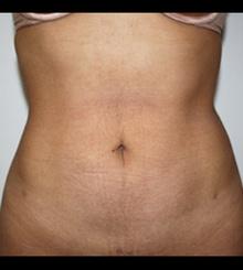 after Body Sculpting 13