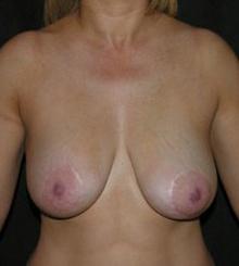 before Breast Lift 37