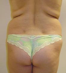 before Brazilian Butt Lift 13