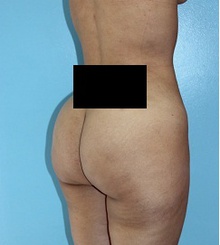 after Brazilian Butt Lift 5