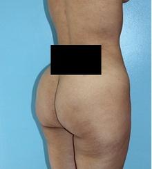 after Brazilian Butt Lift 5