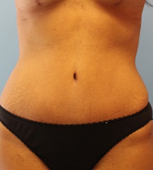 after Tummy Tuck 19