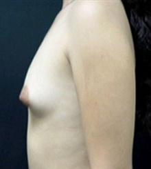 before Breast Augmentation 22