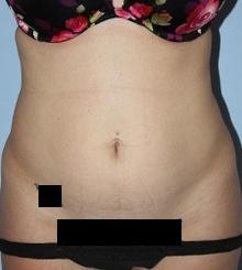 before Body Sculpting 6