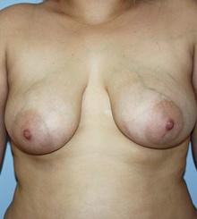 before Breast Lift 16
