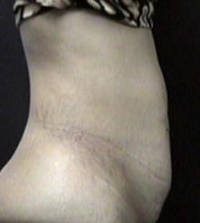 before Tummy Tuck 2