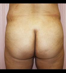 before Brazilian Butt Lift 12