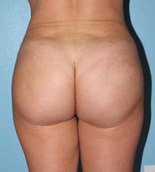 after Brazilian Butt Lift 20