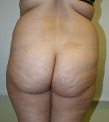 before Brazilian Butt Lift 14