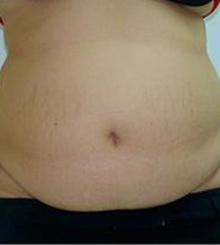 before Tummy Tuck 1