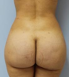 after Brazilian Butt Lift 29
