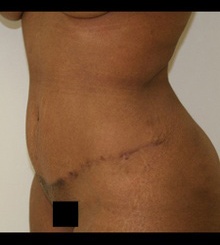 after Tummy Tuck 8