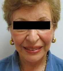after Face Lift 1
