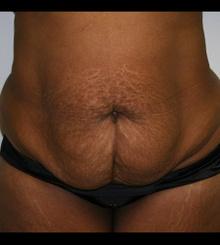 before Tummy Tuck 8