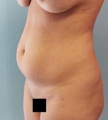 before Brazilian Butt Lift 25