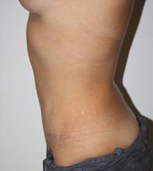 after Tummy Tuck 4