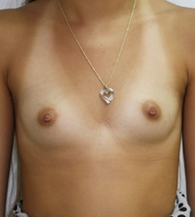 before Breast Augmentation 54