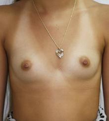 before Breast Augmentation 54