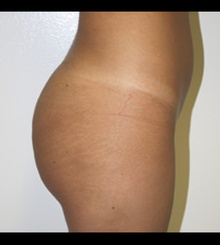 after Brazilian Butt Lift 9