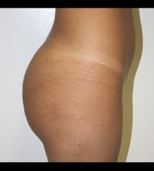 after Brazilian Butt Lift 9