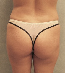 before Brazilian Butt Lift 15