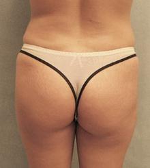 before Brazilian Butt Lift 15