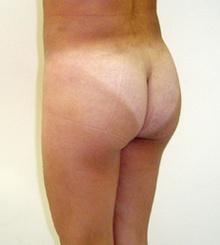 after Brazilian Butt Lift 10