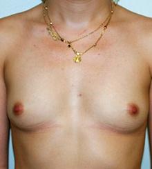 before Breast Augmentation 25
