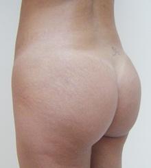 after Brazilian Butt Lift 23