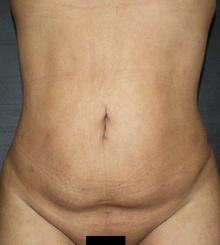 after Body Sculpting 12