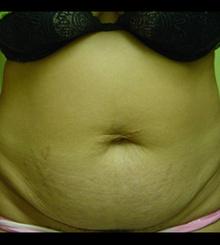 before Tummy Tuck 10