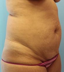 before Tummy Tuck 14
