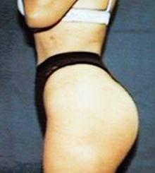 after Brazilian Butt Lift 26