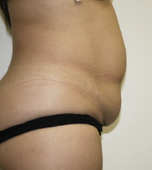 before Tummy Tuck 11