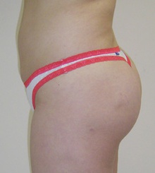 after Brazilian Butt Lift 13
