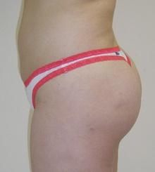 after Brazilian Butt Lift 13
