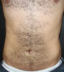 after Body Sculpting 5
